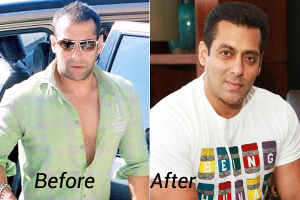 Celebrity Hair Transplant | Top Hair Transplant Center Delhi, Jaipur