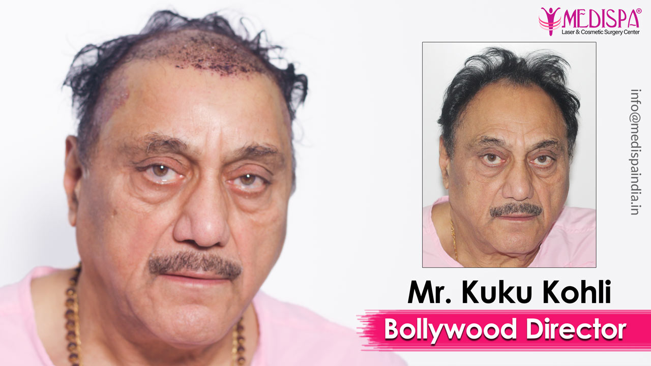 Celebrity Hair Transplant in India | Bollywood Actors Hair Transplant