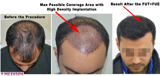 combine-fut-fue-hair-transplants.jpg
