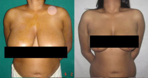 Best Female Breast Reduction Surgery Cost in Delhi India