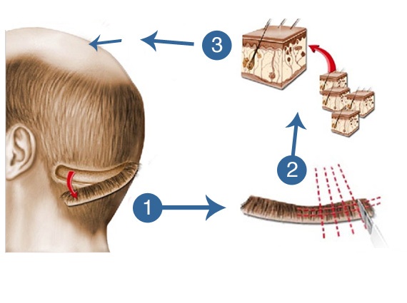 FUT Hair Transplant | Best FUT Hair Transplant in India FUT Hair Transplant | Best FUT Hair Transplant in India