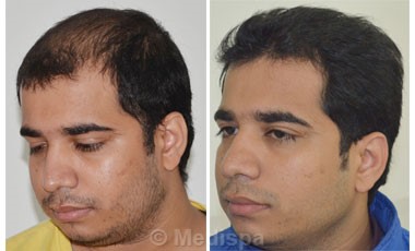 Hair Transplant Clinics in Allahabad – daneelyunus Hair Transplant Clinics in Allahabad – daneelyunus