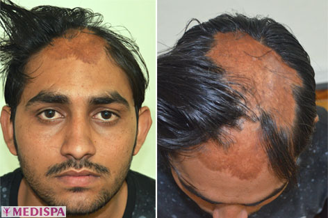 Burn Hair Transplant India | Hair Transplant for Burn Victim Burn Hair Transplant India | Hair Transplant for Burn Victim