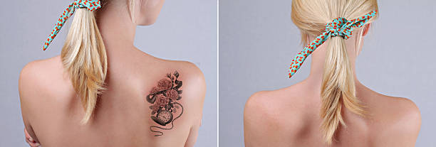 Warts Moles Tattoos Treatment Service at best price in Thane | ID:  22008977730