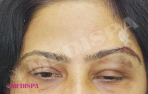 Eyebrow hair transplant discount
