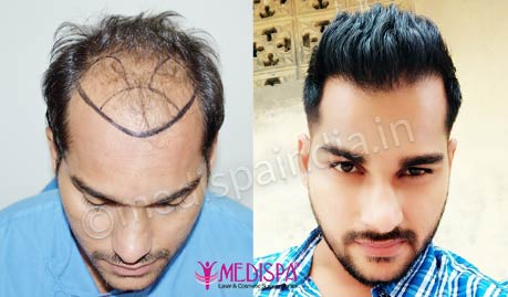 Hair Transplant in USA (United States) | Medispa Clinic India