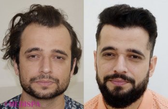 hair transplant in jaipur