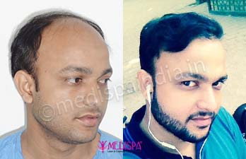 How to select Hair Transplant Surgeon in Bangalore?