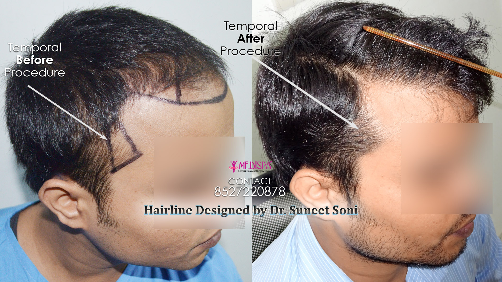 5 Best Hair Transplant Doctors in India