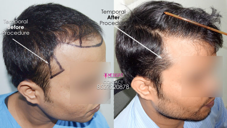 Hair Transplant in India