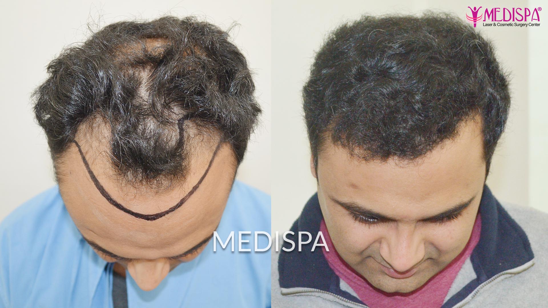 Is it Costly to Get the Bio-stimulated FUT+FUE Hair Transplant