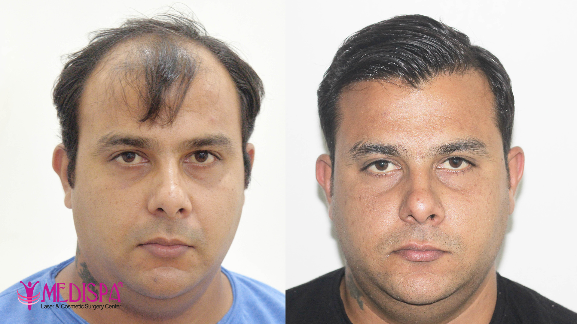 Image result for Hair transplant
