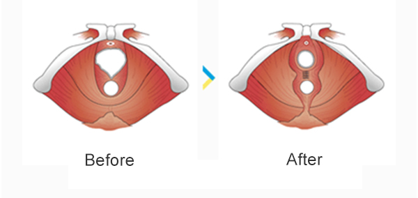 Hymenoplasty Top Hymenoplasty Surgery Delhi Jaipur Medispa India