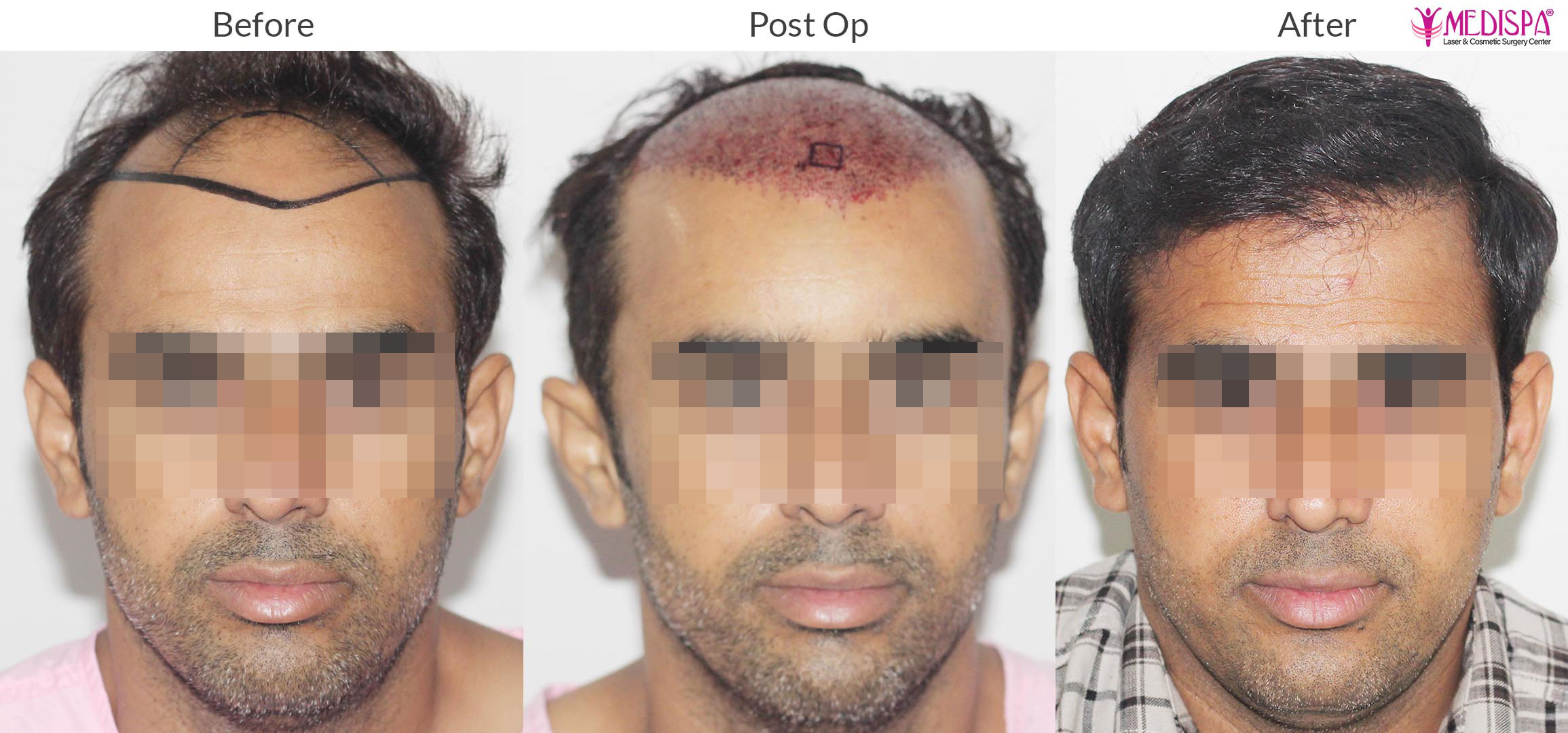 Why Hair Transplant is considered a safe procedure for Everyone? Why Hair Transplant is considered a safe procedure for Everyone?