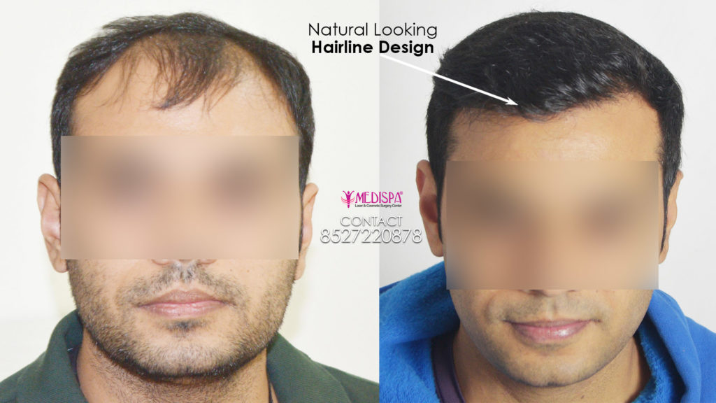 Principles of hair line : Importance of Hairline Design