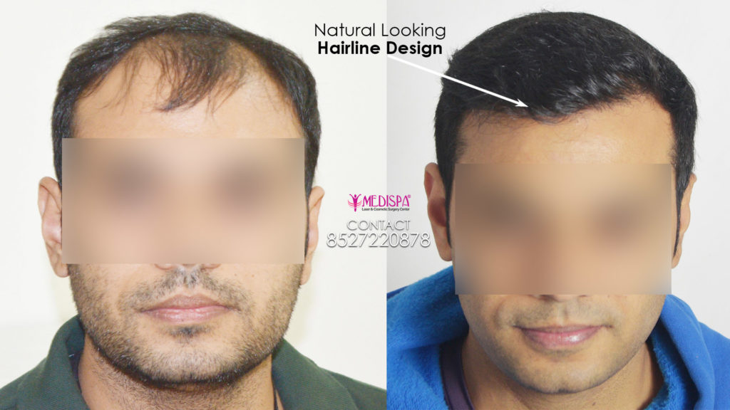 Principles of hair line : Importance of Hairline Design Principles of hair line : Importance of Hairline Design