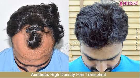Maximum Hair Density | High Density Hair Transplant - India