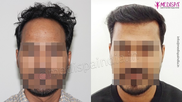 Hair transplant in Ajmer