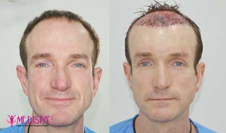 Hair Transplant in Italy | Hair Transplant Cost in Italy