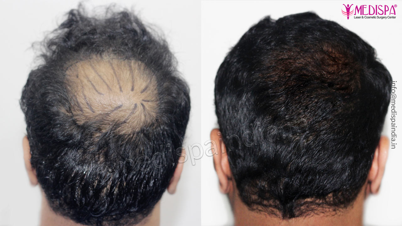 burn hair transplant india