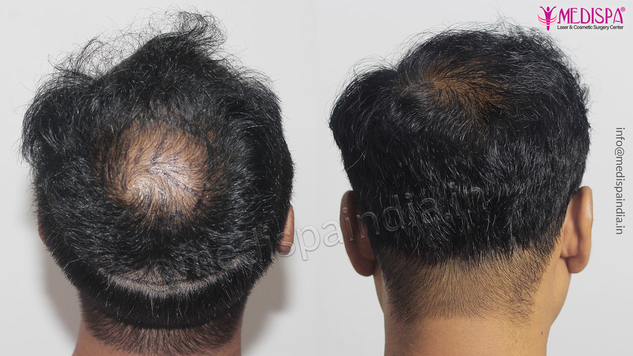 vertex hair transplant results india