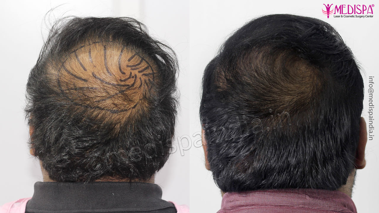 Vertex Hair Transplant Photo Gallery Hair Transplant in Delhi | Hair Transplant Cost in Delhi Clinic Vertex Hair Transplant Photo Gallery Hair Transplant in Delhi | Hair Transplant Cost in Delhi Clinic