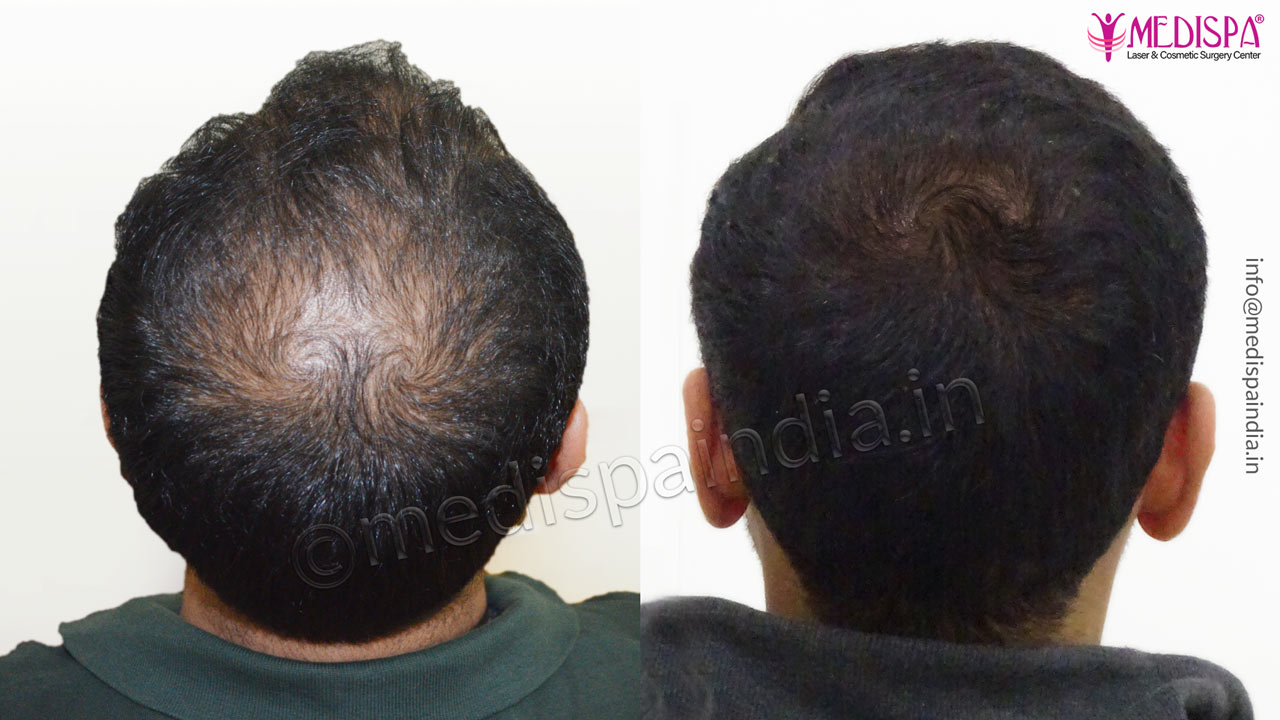 vertex hair transplant india