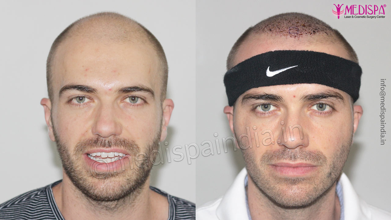 hair transplant delhi cost