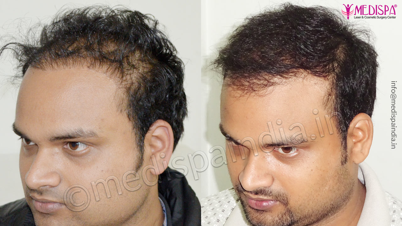 best hair transplant results in india