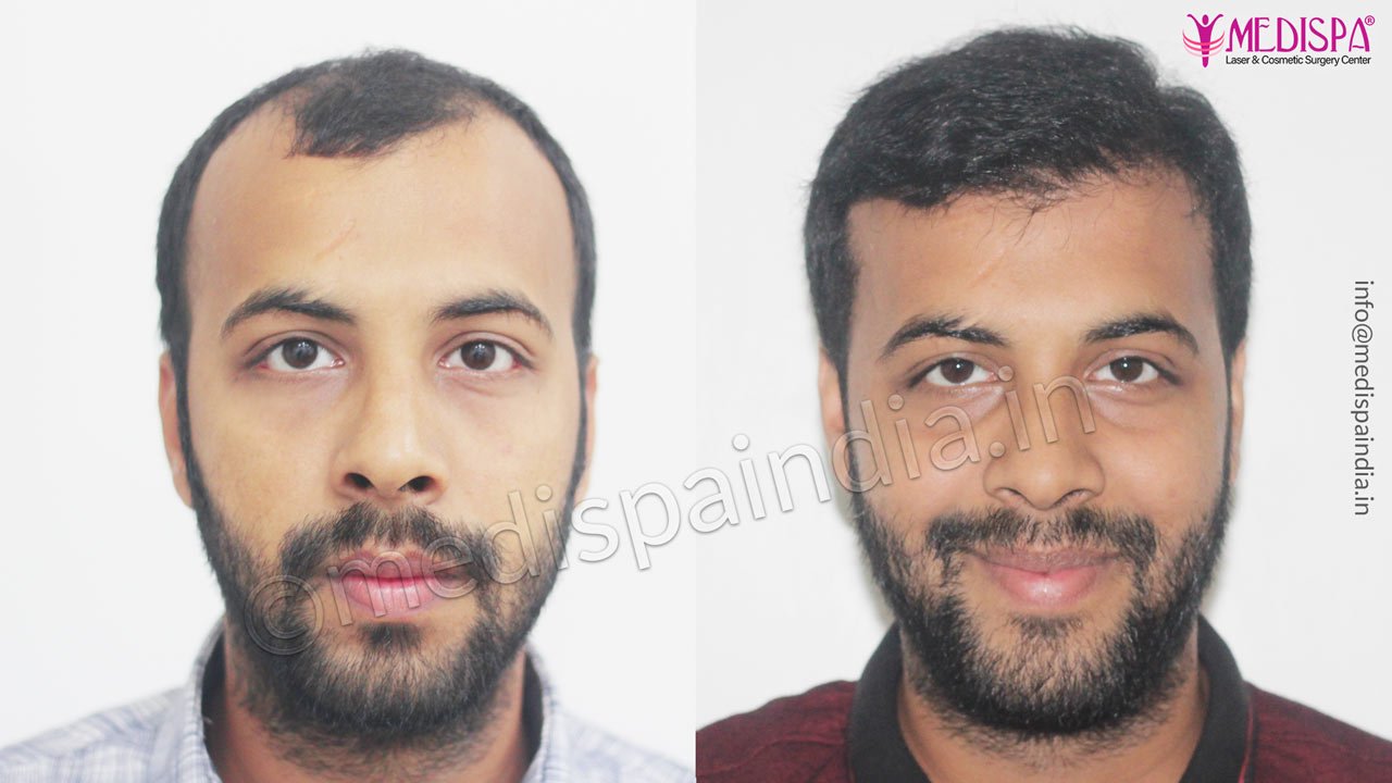 hair transplant cost in india