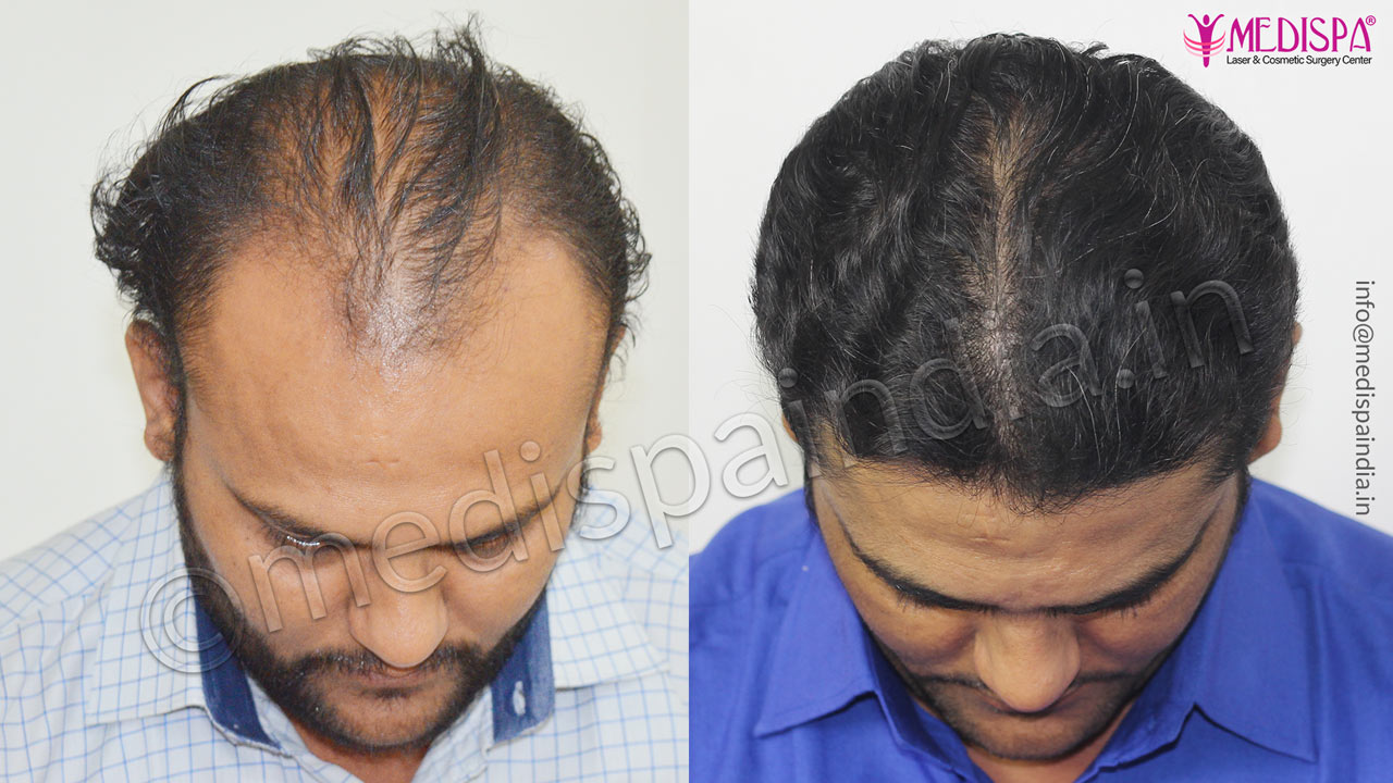 hair transplant cost in dubai