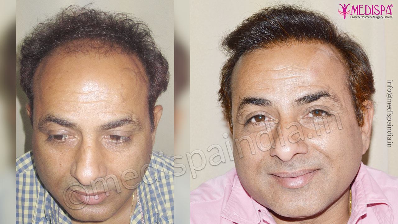 best wrong hair transplant results delhi