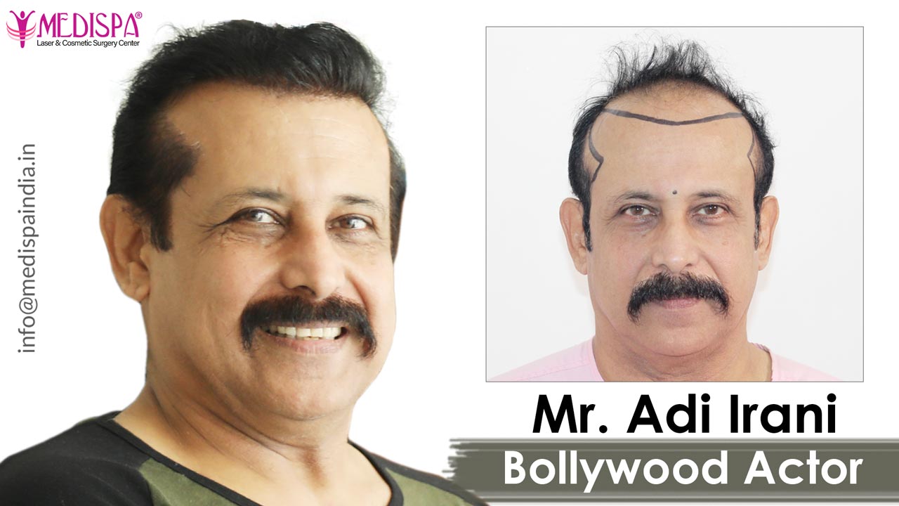 celebrity hair transplant india