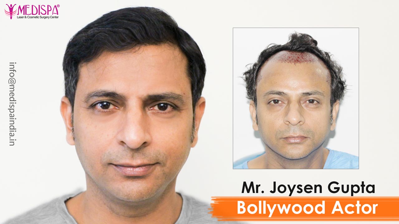 hair transplant in jaipur