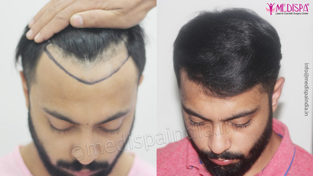 Best Hair Transplant Doctor in India - Dr Suneet Soni