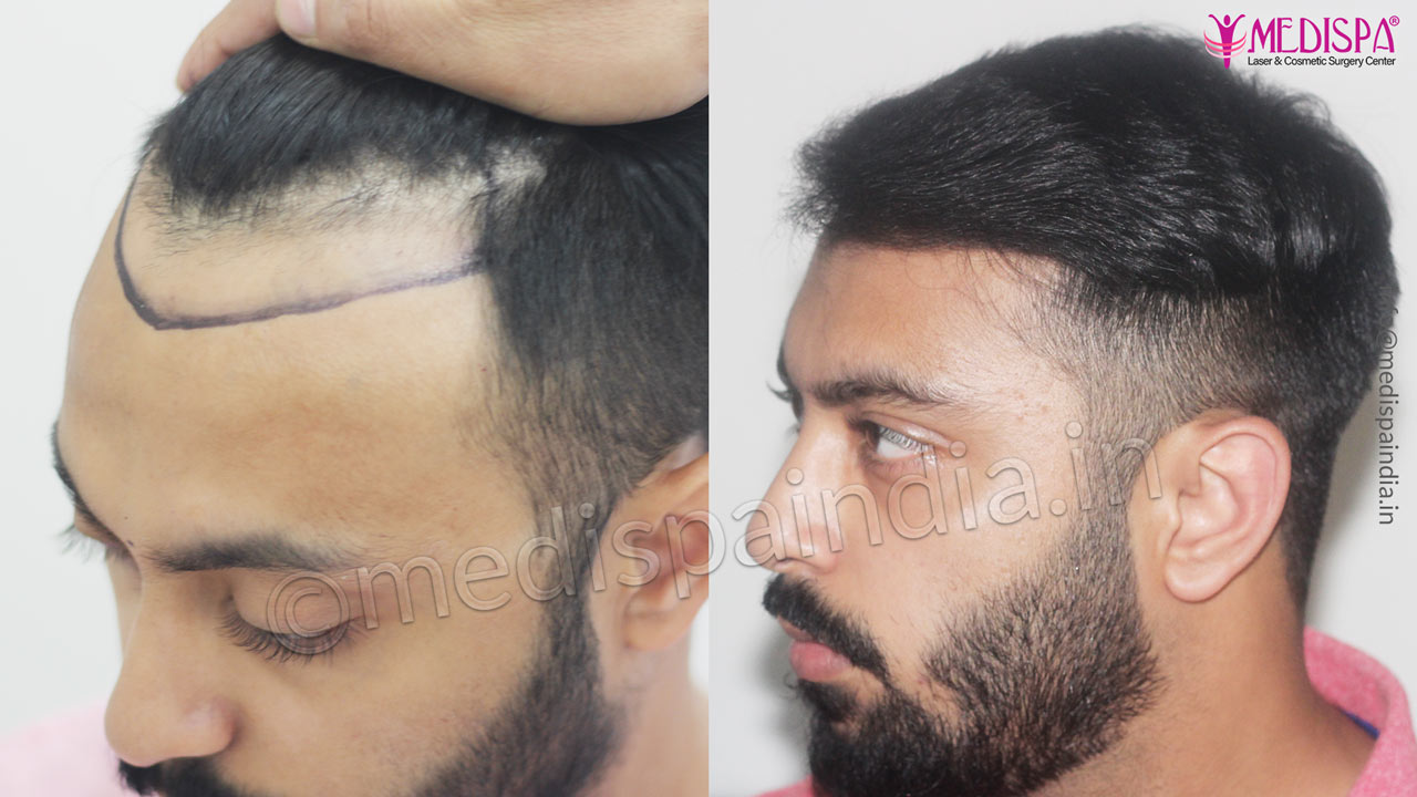 hair transplant cost in india