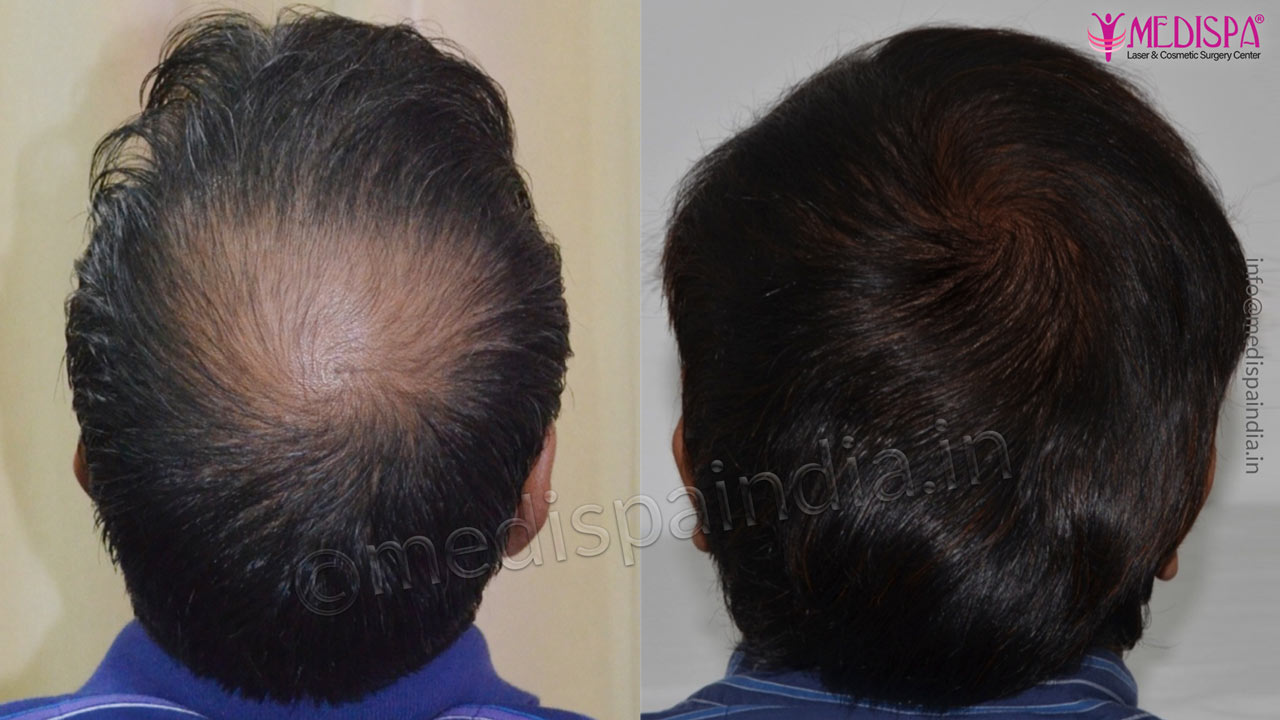 vertex hair transplant results india