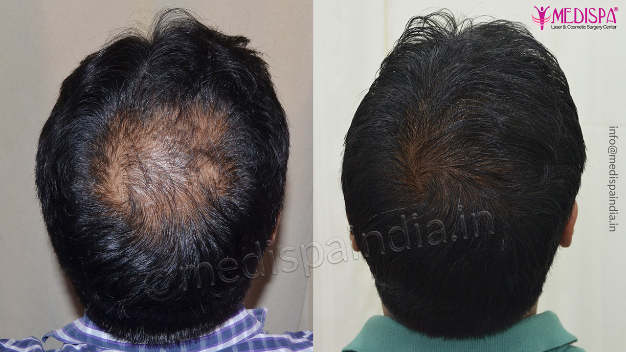 vertex hair transplant results india