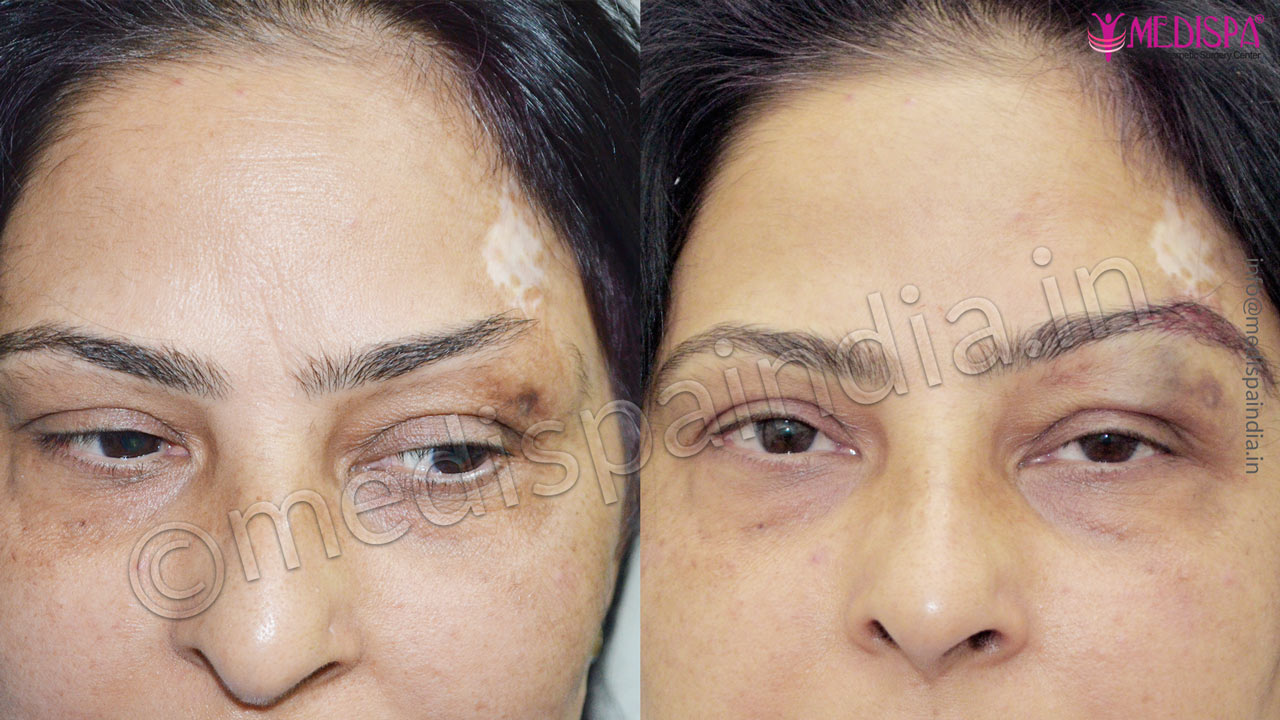 eyebrow hair transplant results india