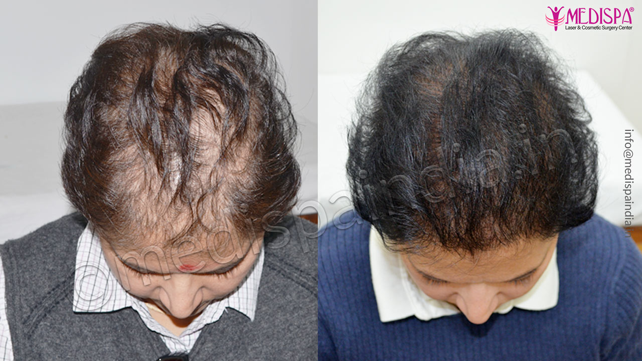 female hair transplant cost delhi