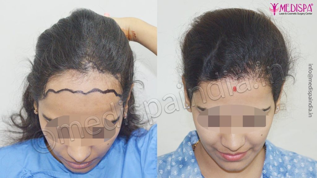 Female Hair Transplant | Women Hair Transplant Cost in India Female Hair Transplant | Women Hair Transplant Cost in India