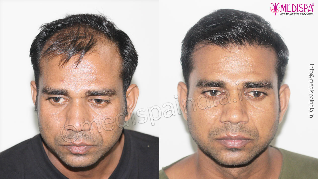 Male Hair Transplant Photo Gallery Hair Transplant in Delhi | Hair Transplant Cost in Delhi Clinic Male Hair Transplant Photo Gallery Hair Transplant in Delhi | Hair Transplant Cost in Delhi Clinic