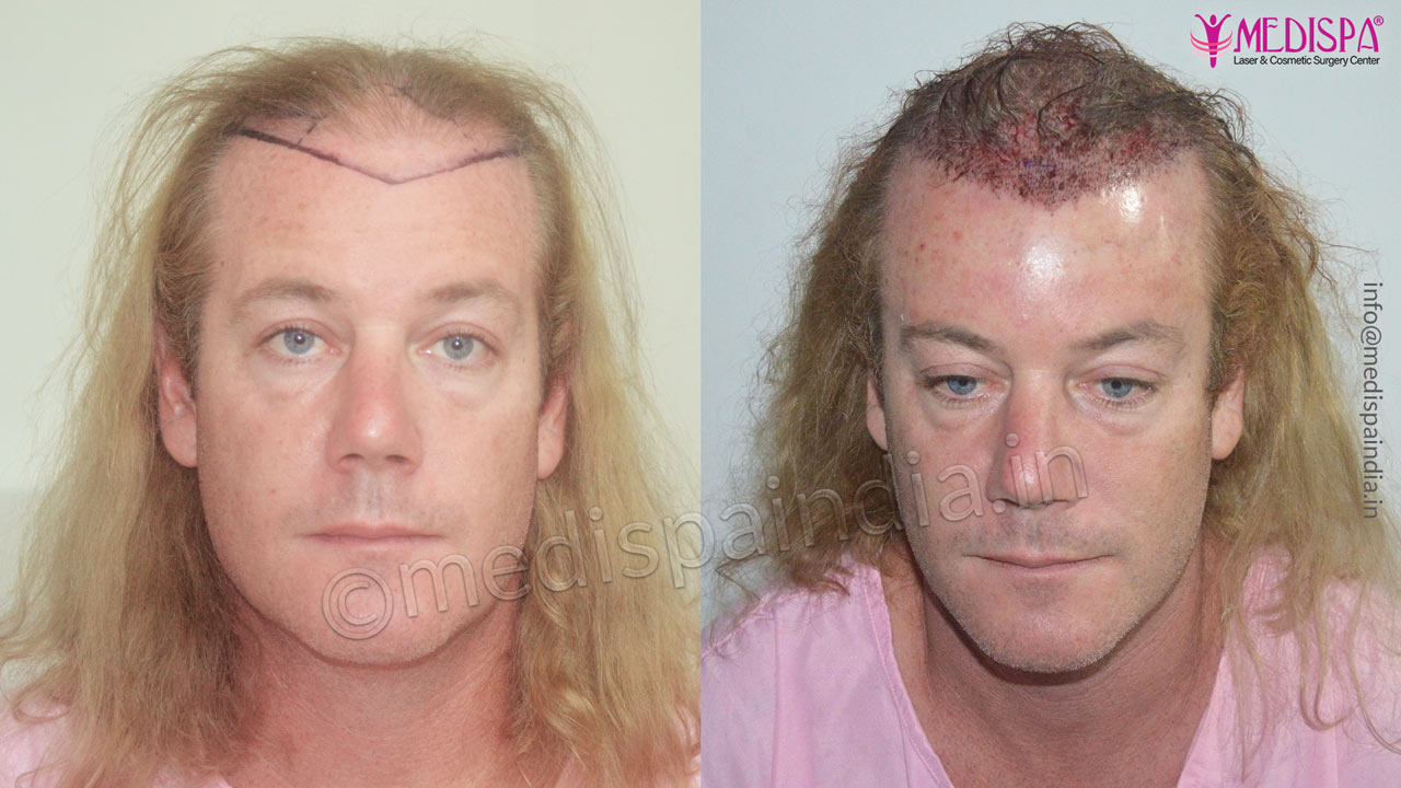 hair transplant in Australia