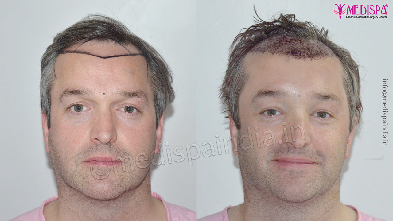 hair transplant cost in usa