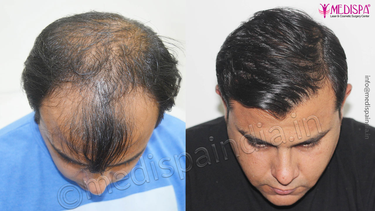 celebrity hair transplant 