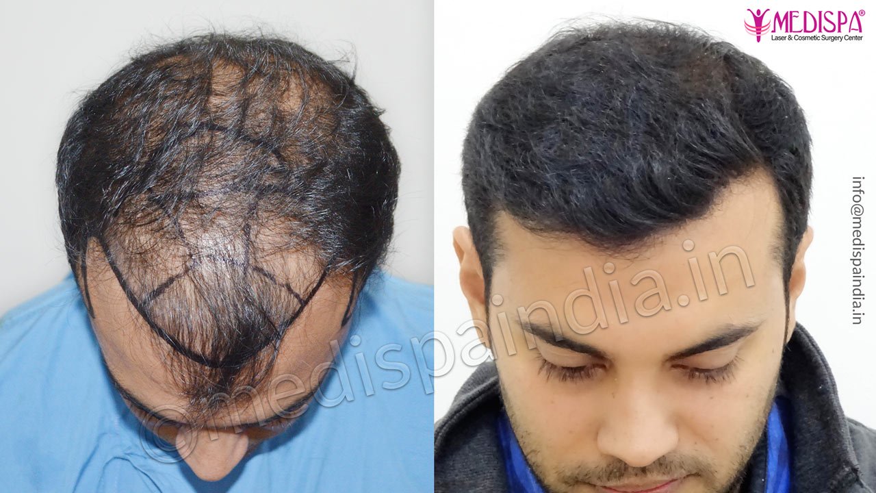 Jaipur hair transplant result