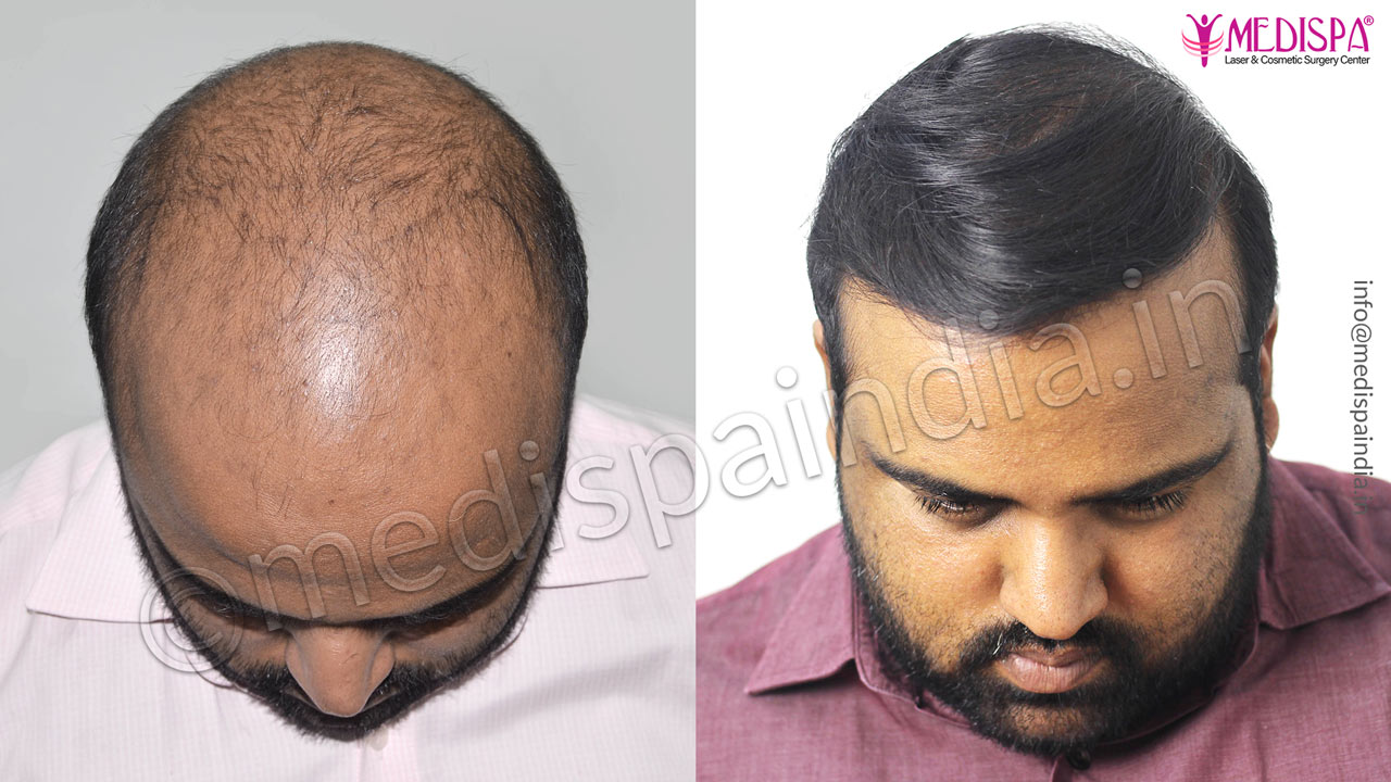 Gurgaon hair transplant result