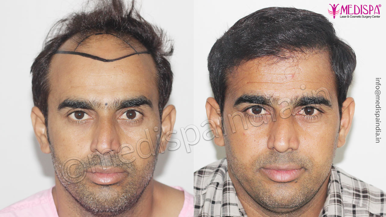 hair transplant result