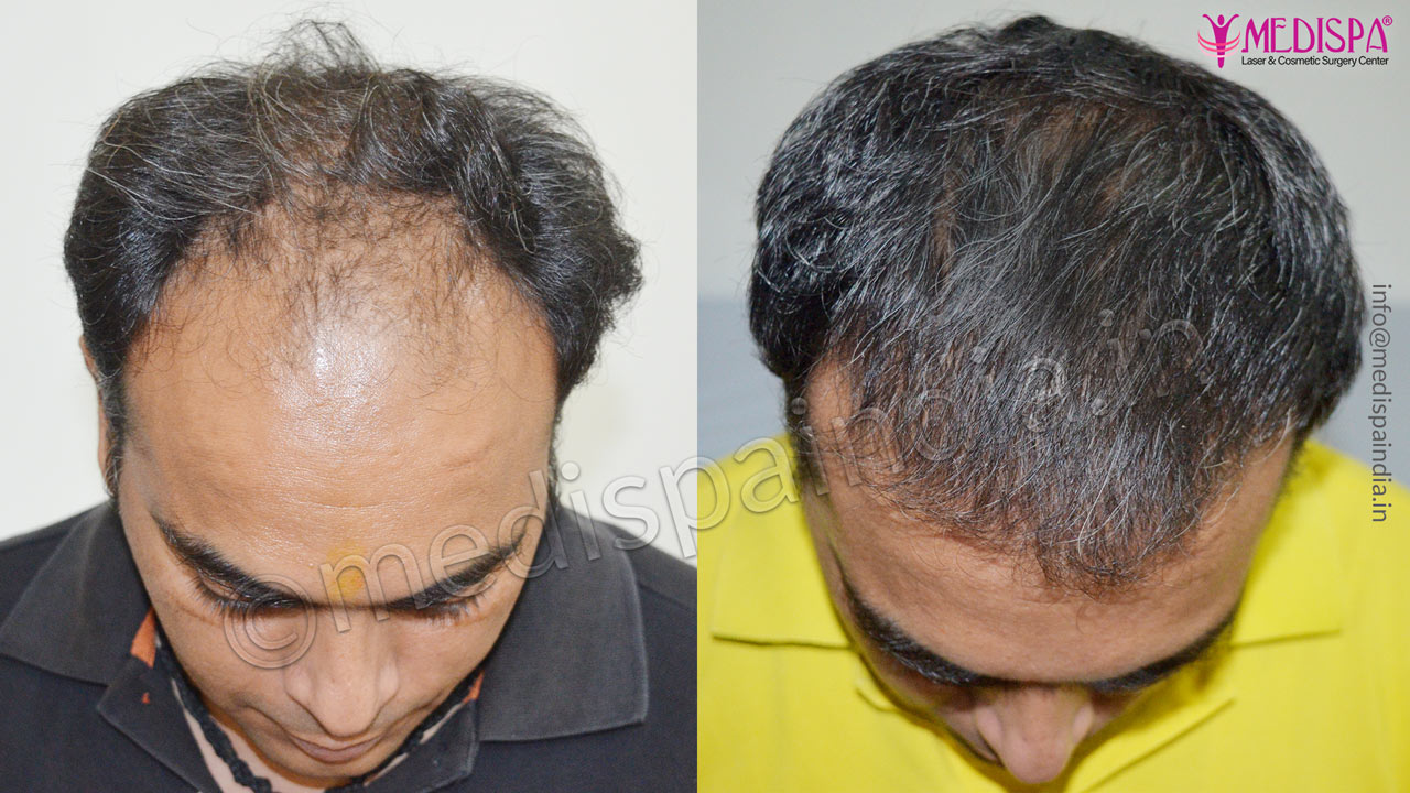 hair transplant delhi cost