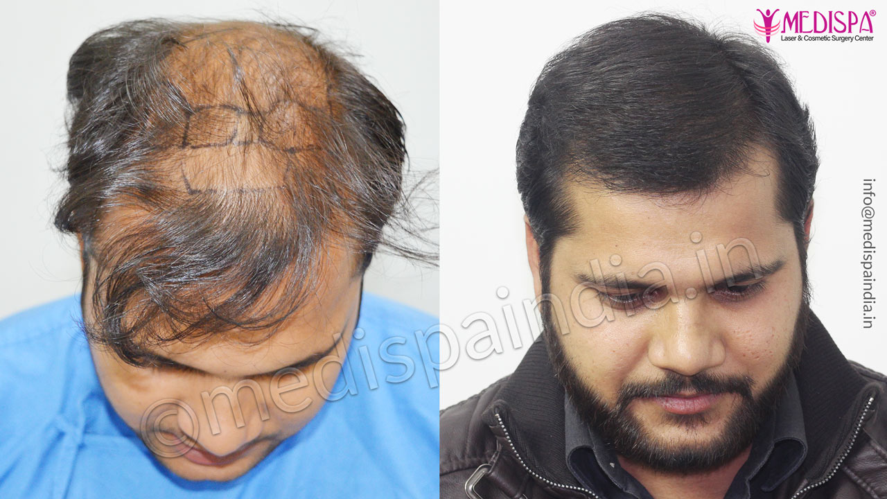cost of hair transplant india